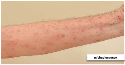 mengenal penyakit scabies  kudis pengobatan  konsultasi medis