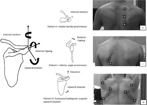 Scapular dyskinesis: Patterns, functional disability and associated ...