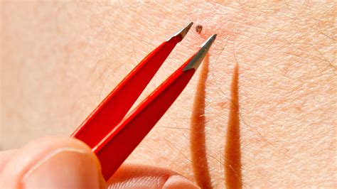 Learn The Hidden Dangers Of A Popped Ingrown Hair And How To Properly Treat Your Skin Afterward Today 3