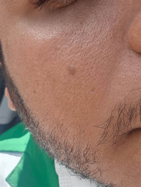 Sinal No Rosto Preto - Estou com esse sinal no rosto a alguns anos, mas percebi que ele ...