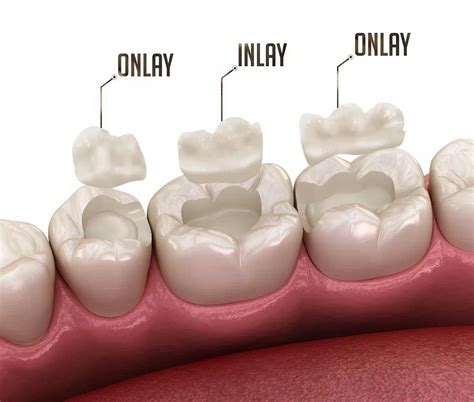 inlay onlay overlay actualites