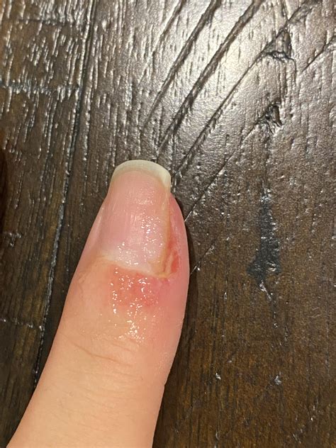Periungual wart update (4+ months) : r/Warts