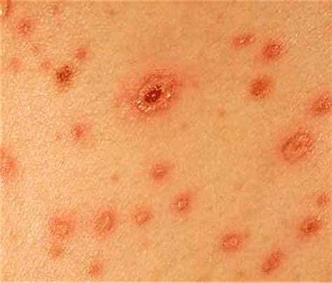 What Do Chiggers Bite Look Like at William Gutirrez blog