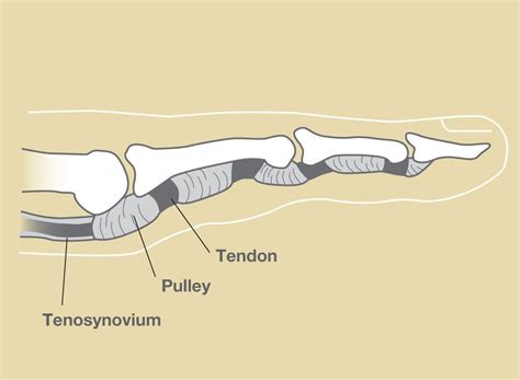 Trigger Finger - Jackson Orthopaedics Jackson Orthopaedics