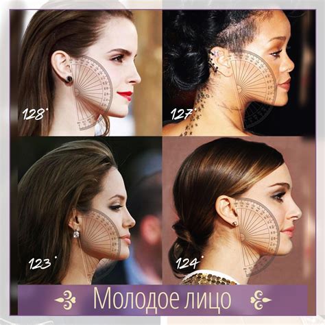 Углы нижней челюсти: коррекция филлерами.