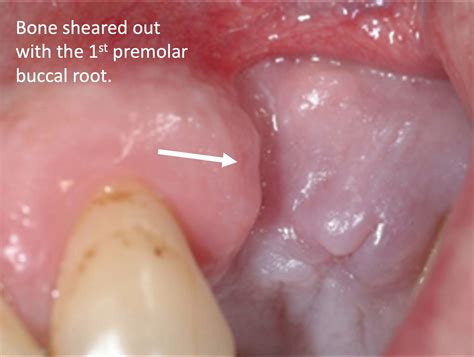 maxillary st premolar