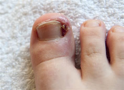 Severe Ingrown Toenail Ingrown Toenail Removal