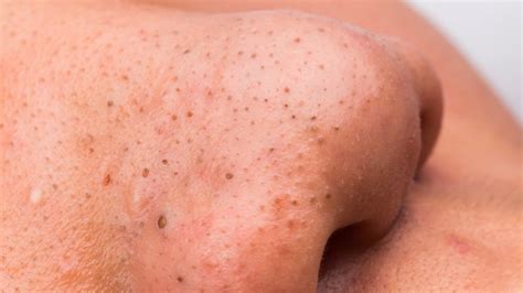 This Unbelievable Blackhead Removal 2024 Method is Taking Over TikTok! - 5xg6lji