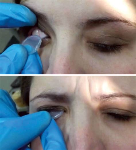 Amniotic Membrane Usage Up Over the Decade, Mostly by ODs for Dry Eye