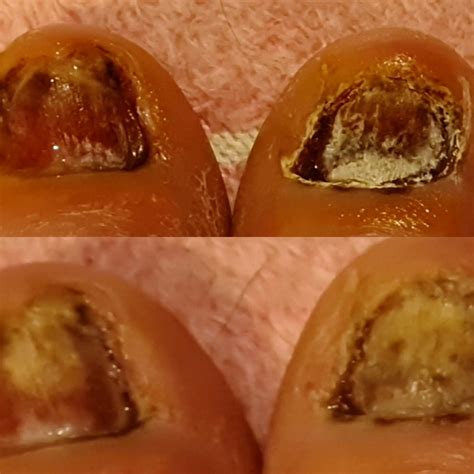 Had both of my big toenails taken off due to ingrowing toenails : r