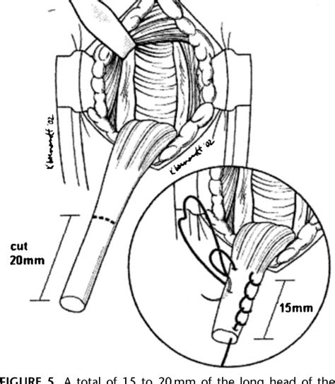 Figure 3 from Subpectoral biceps tenodesis. | Semantic Scholar