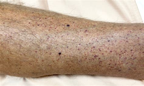 Petechiae - Symptoms, Causes, Treatment and Prevention-Ask Apollo Blog