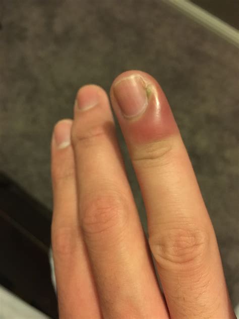 finger swollen   weeks    healing    concerned