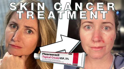 Skin Cancer Treatment Cream