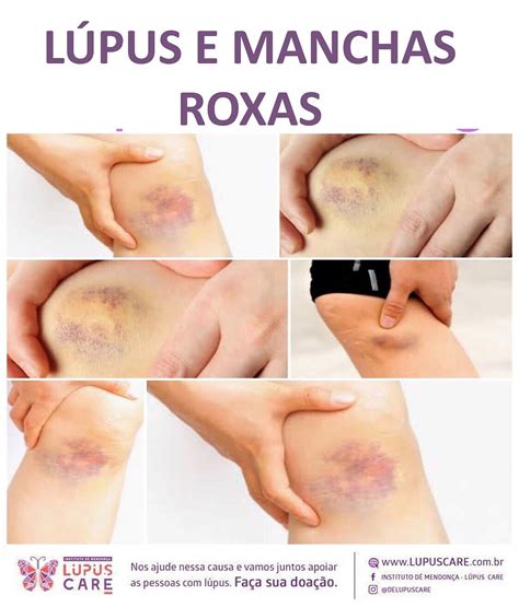Mancha Roxa Na Coxa O Que Pode Ser