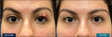What Does Your Eye Look Like After Chalazion Surgery Mean - Infoupdate.org