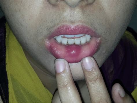 photograph  cystic swelling  lip diagnosed  tuberculous lesion