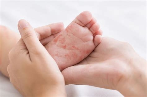 kasus campak meningkat berikut  ciri  pengobatan penyakit campak