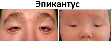 Что такое эпикантус глаз