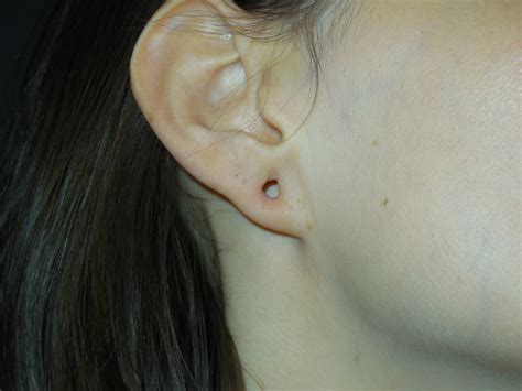 Ear Lobe Repair - Dr Cynthia Goodman