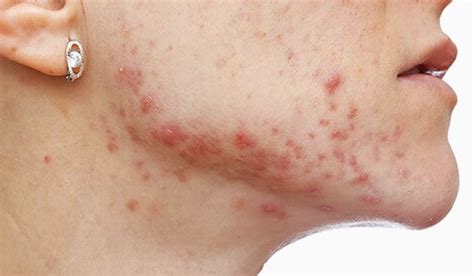 How to treat fungal acne? • Hama Store