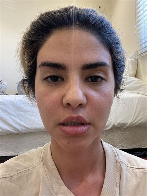 3 months post operation of double jaw surgery and genioplasty, I can’t