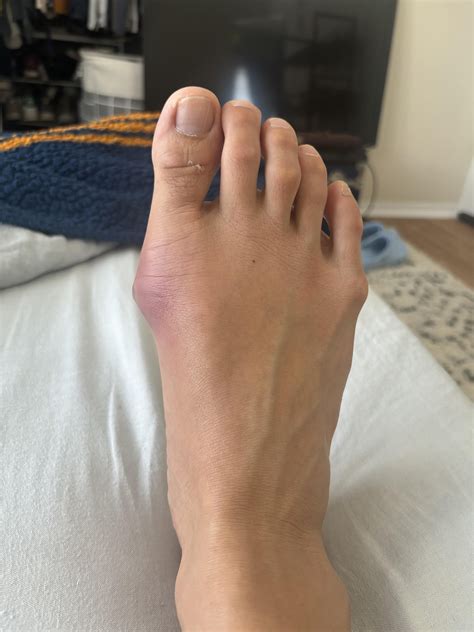 Bunion flare up - bruised : r/bunions