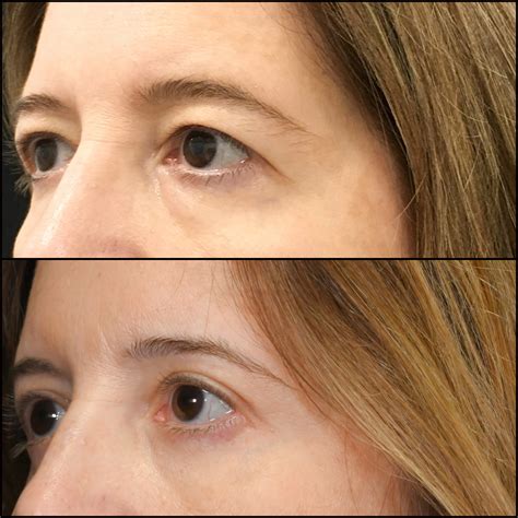 Upper Blepharoplasty Before & After Photos | Flora Levin MD