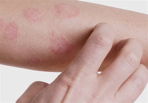 O Que Pode Causar Dermatite - Dermatite - O que é, sintomas, tipos da doença e como tratar