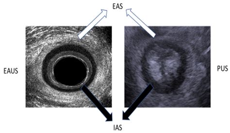 Combined 3D Endoanal Ultrasound and Transperineal Ultrasound Improves