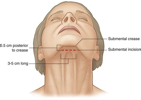 Rhytidectomy and Neck Rejuvenation | Plastic Surgery Key