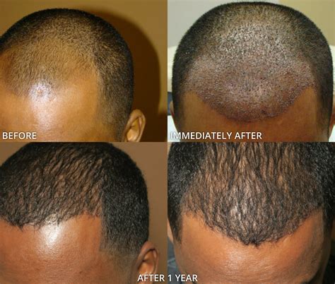 hair transplant    fue  ella dierking blog