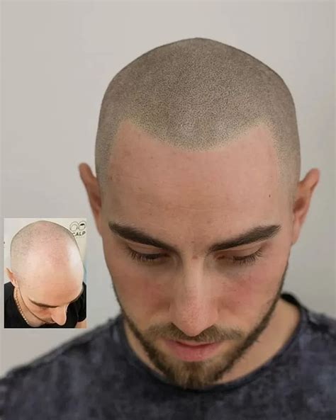 The Best Scalp Micropigmentation Results - Scalp Micro USA