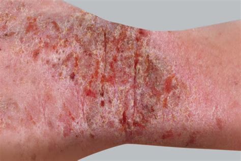 Atopic Dermatitis Risks and Eczema Causes | Genetics, Environment, and ...