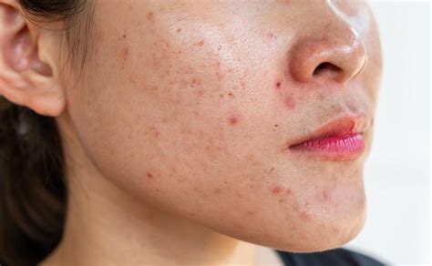 whats causing  adult acne sanford dermatology