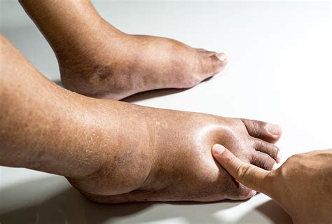 Caring For Seniors With Edema – Welcome To Agecare