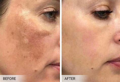 BioRepeel New York, BioRepeel Facial In Staten Island & Brooklyn ...