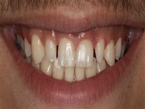 Dente