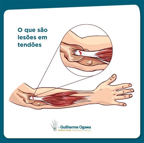 O Que São Os Tendões - Lesões em tendões: Tipos e tratamentos – Guilherme Ogawa