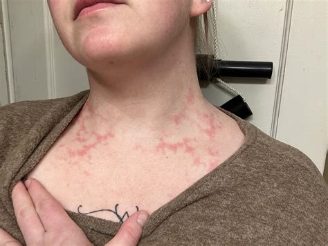 After a sauna and cold plunge event, a lot of my skin looked like this