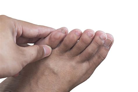 prevention  blisters   prevent