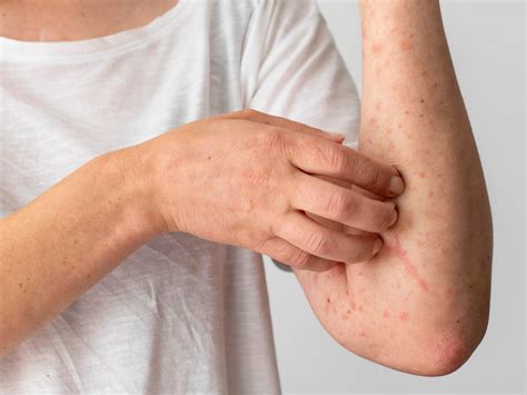 Atopic dermatitis - Health Tips, Atopic dermatitis Health Articles ...