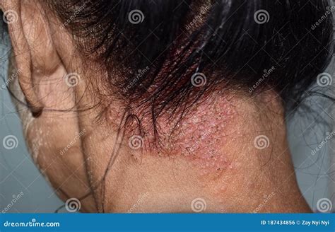 Seborrheic Dermatitis or Fungal Skin Infection at the Scalp of ...