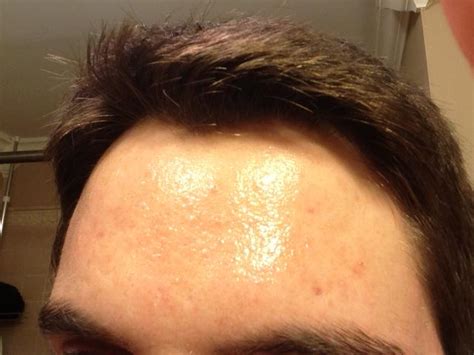 forehead   greasyshiny      emits