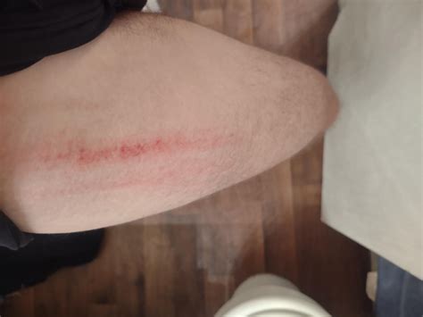 Red rash-like line down my thigh after running? : r/RunningInjuries