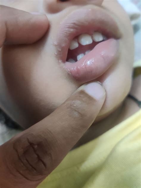 White bumps on lips corner | BabyCenter