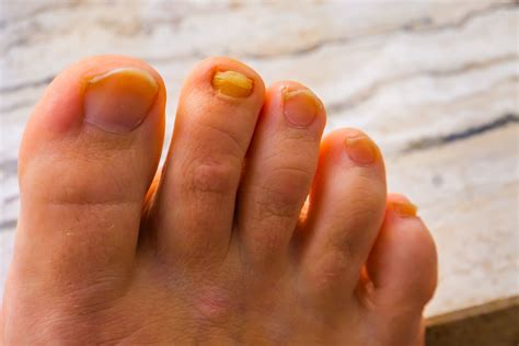 Yellow Nails? Common Causes and How to Fix Them