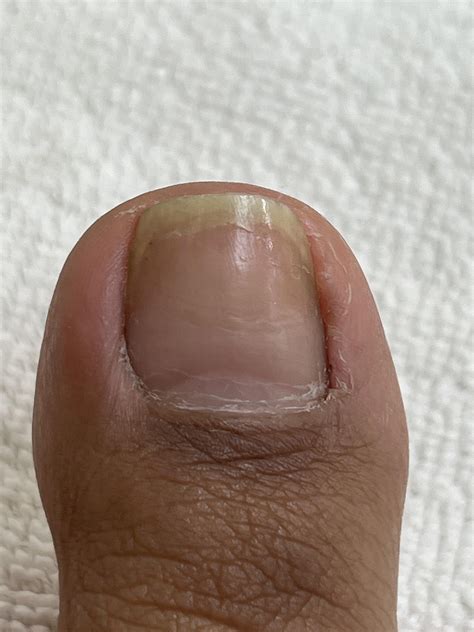 Is this toe fungus : r/NailFungus