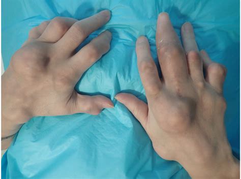 What Are Nodules In Rheumatoid Arthritis at Lester Shippy blog