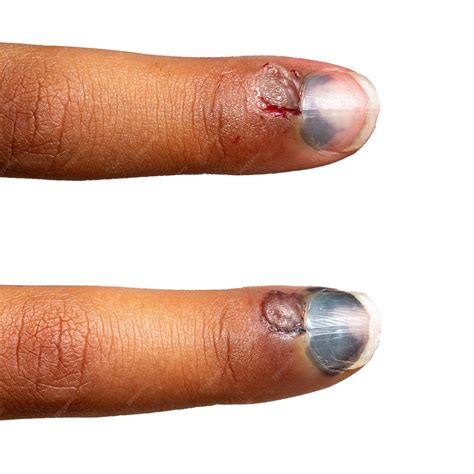 Unha Quebrou No Meio Do Dedo - Evolução após alguns dias do hematoma de uma colagem de dedo esmagado ...